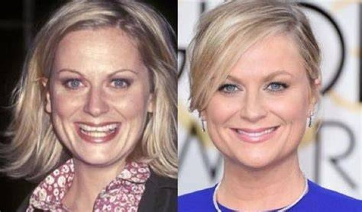 Amy Poehler Plastic Surgery Before and After