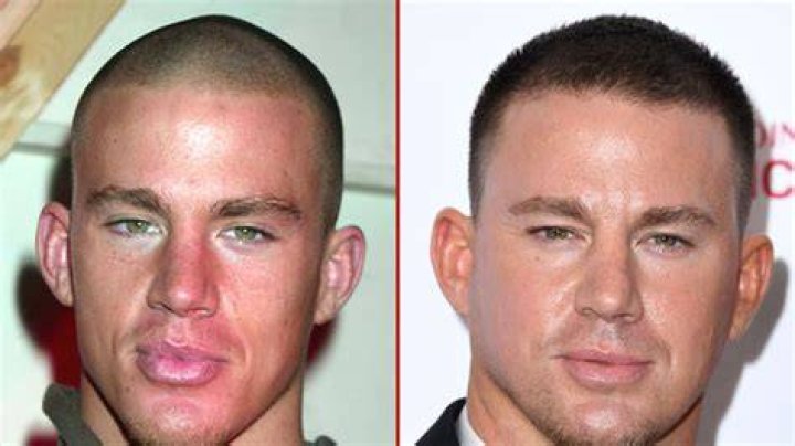 Channing Tatum Plastic Surgery Before and After