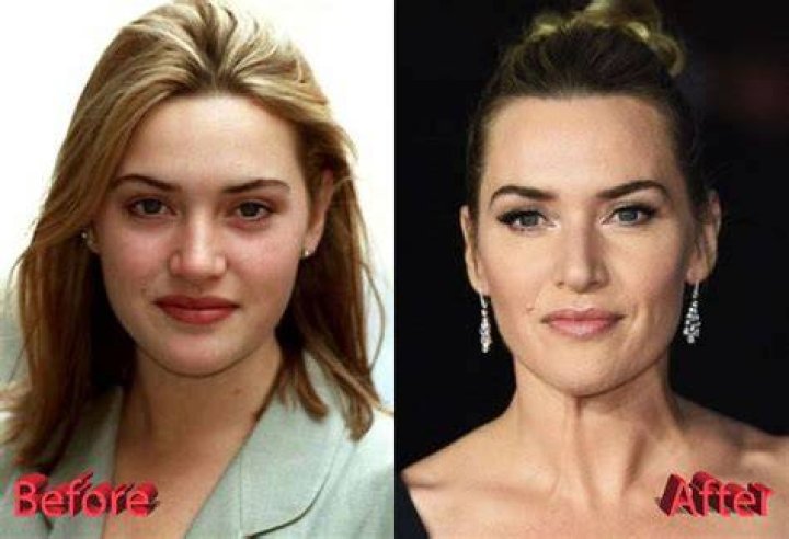 Kate Winslet Plastic Surgery Before and After