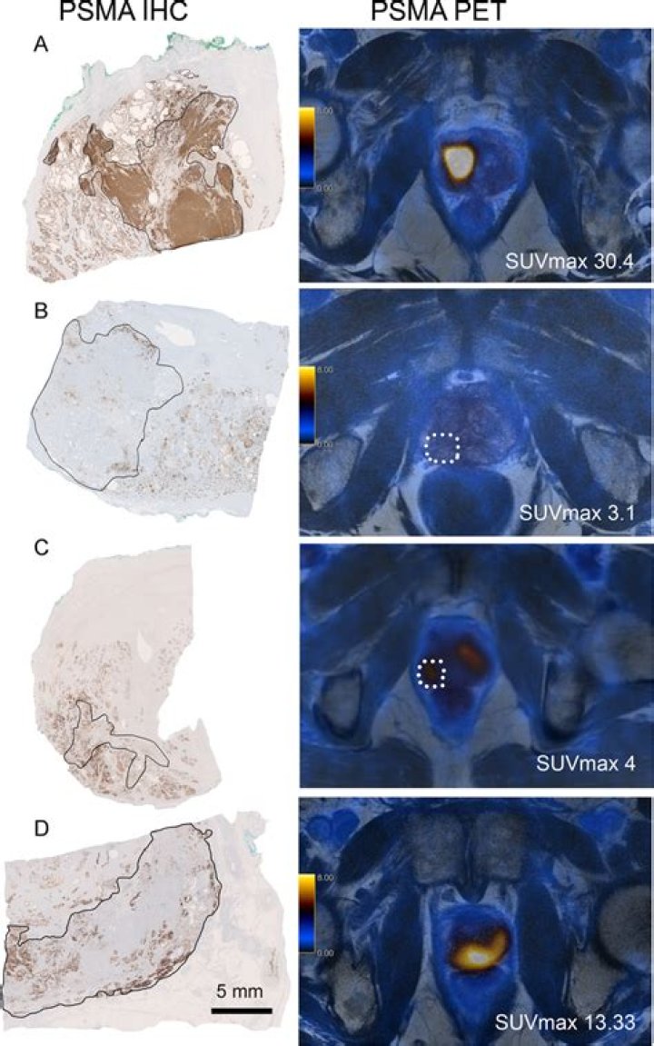 PSMA PET Academy - Case Discussion: PSMA for Biochemical Recurrence and SRT Planning: Early Biochemical Relapse in Patients - Jeremie Calais, Michael Morris, & Alberto Briganti