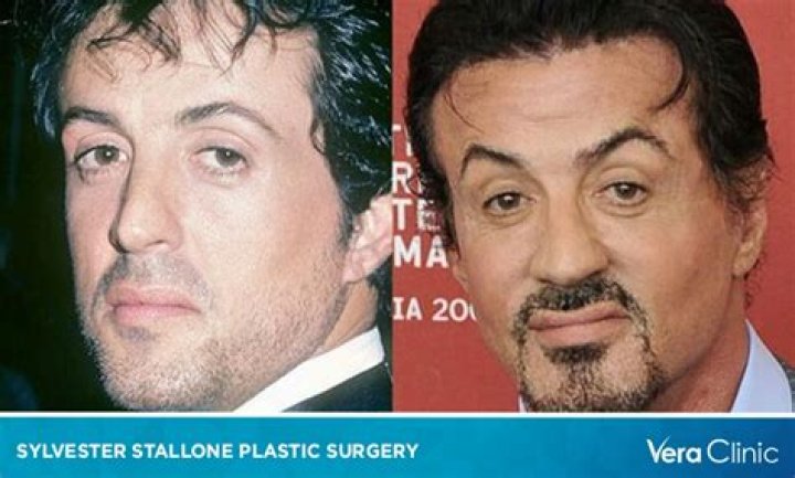 Sylvester Stallone Plastic Surgery Before and After